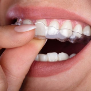 TÕHUS KAPERAVI: hambad saavad sirgeks diskreetselt ja valutult