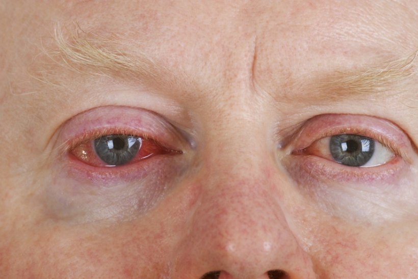 Punane silm - levinud silmapõletik, mis levib väga edukalt koolides