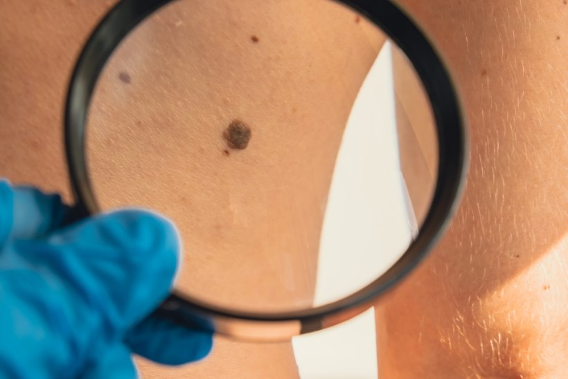 PAHALOOMULISED MUUTUSED: Eesti inimestel on melanoomi aina rohkem