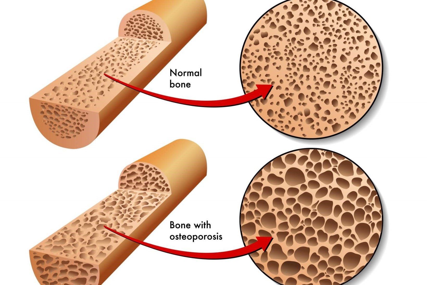 Osteoporoos diagnoositakse üha rohkematel inimestel