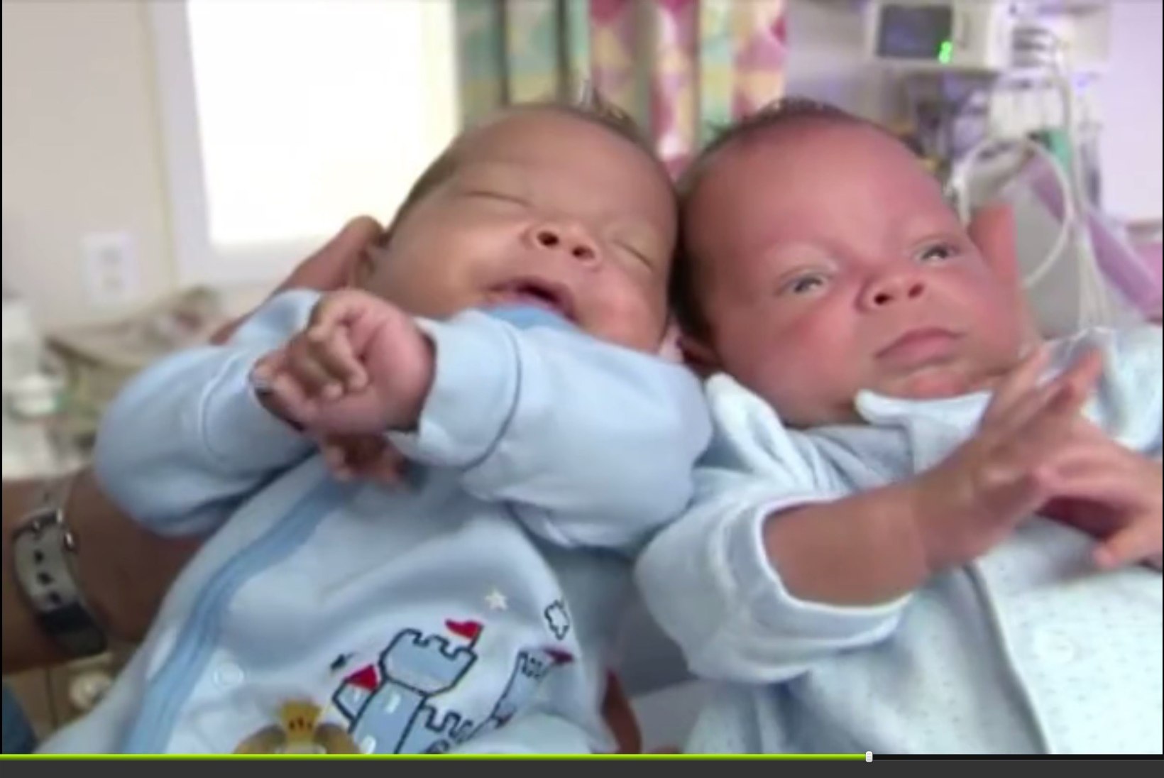 Üks kaksik sündis teisest 24 päeva hiljem