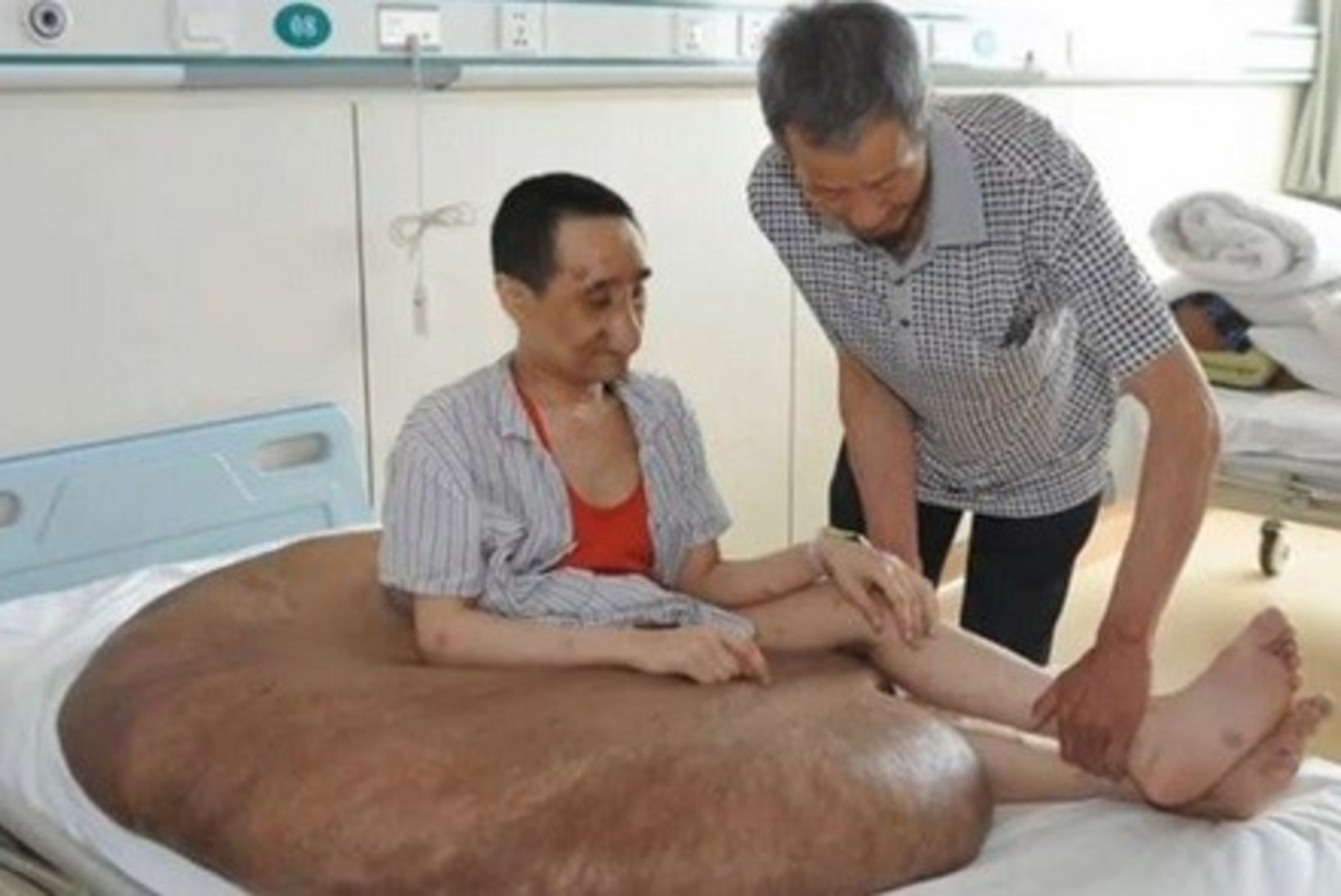 FOTO: mehe jalalt eemaldati 100-kilone kasvaja