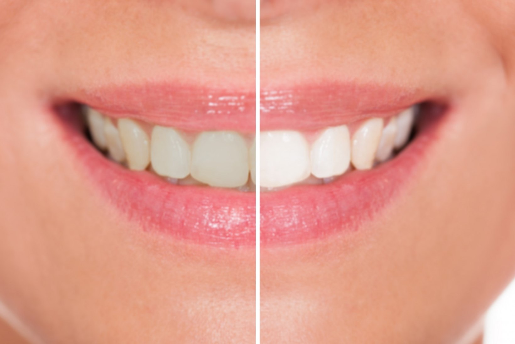 Hambavalgenduse ohud: ülevalgendatud naeratusest hambajuure kahjustuseni