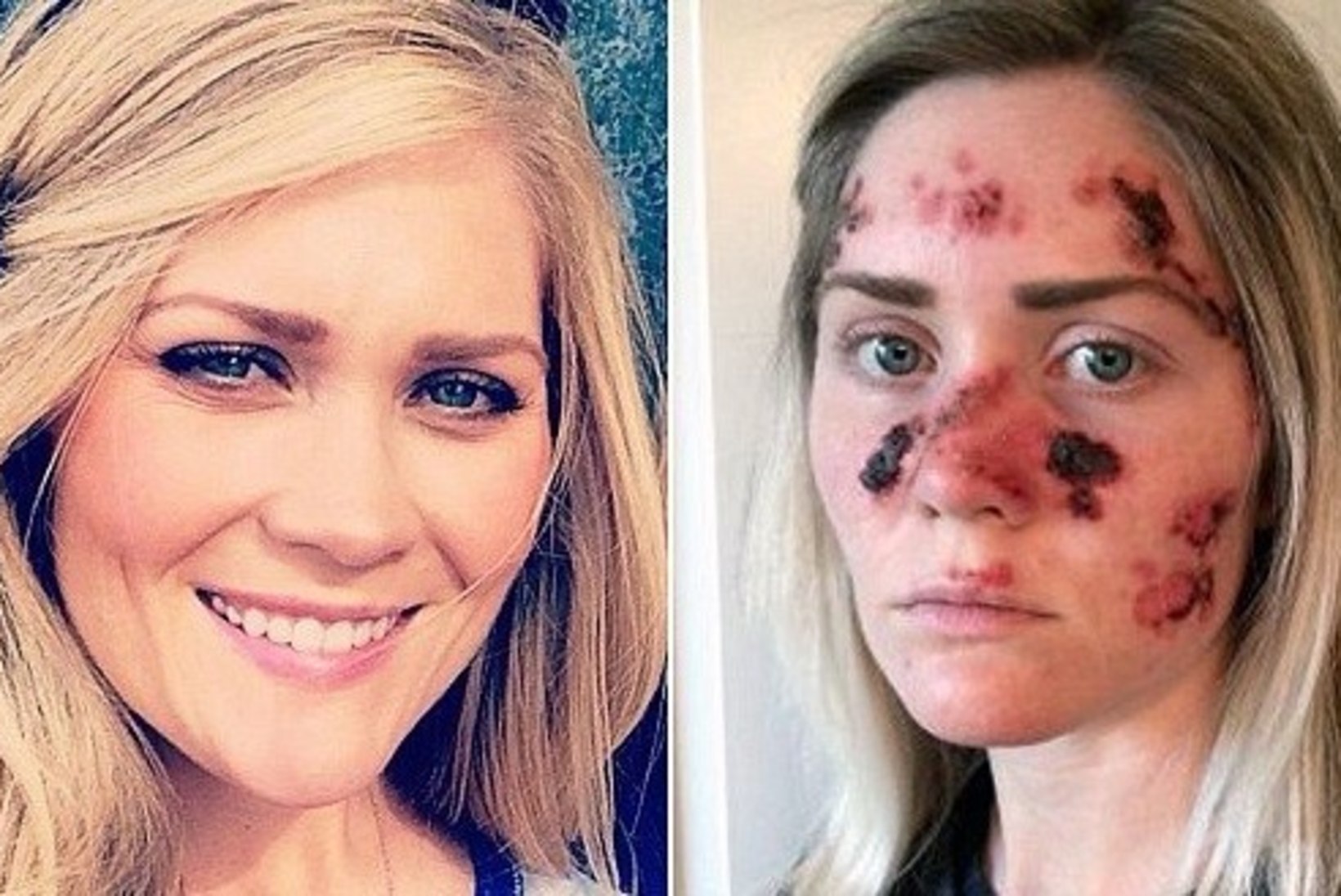 SOLAARIUMIS PÄEVITADES MEENUTA: julge naine avalikustas fotod sellest, mida on teinud nahavähk tema näoga...