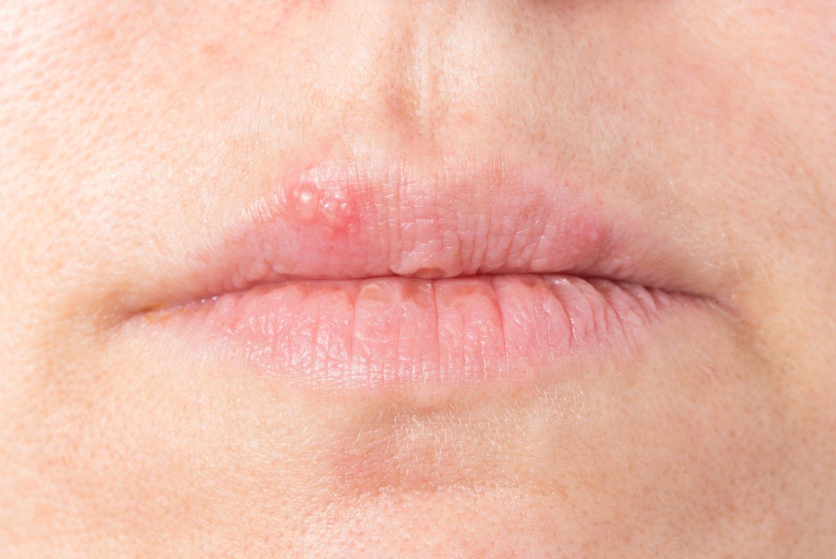 Külmad ilmad toovad valusa ohatise huulele – kuidas seda ennetada ja vältida?
