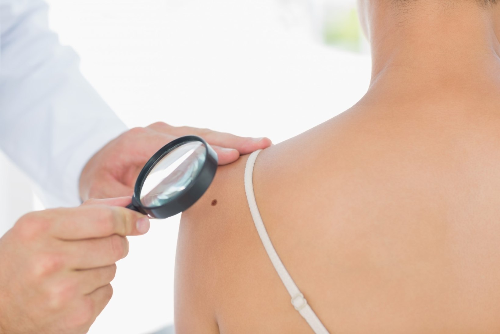 Põhjamaades tõuseb haigestumine melanoomi: viska enne kevadet sünnimärkidele pilk peale