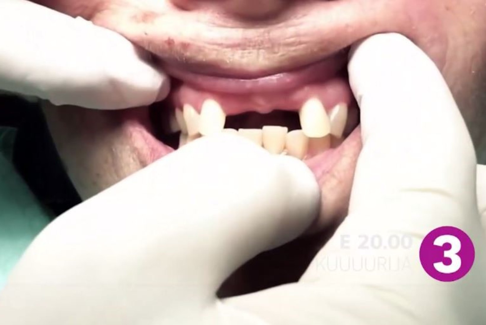 TV3 VIDEO | „KUUUURIJA“: Hambahaldjas Heino Kalm teeb eestlaste hambad taskuraha eest korda!