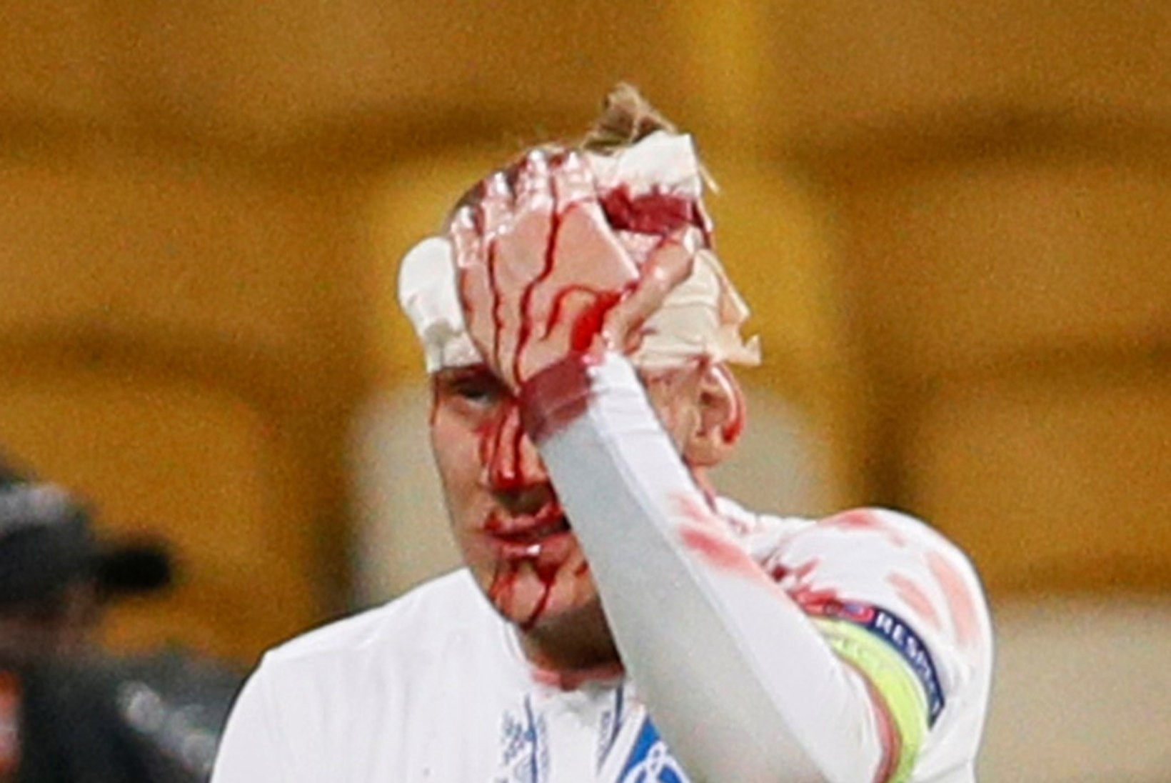 JUBEDAD FOTOD | Ukraina klubi kapteni mäng lõppes verise näoga