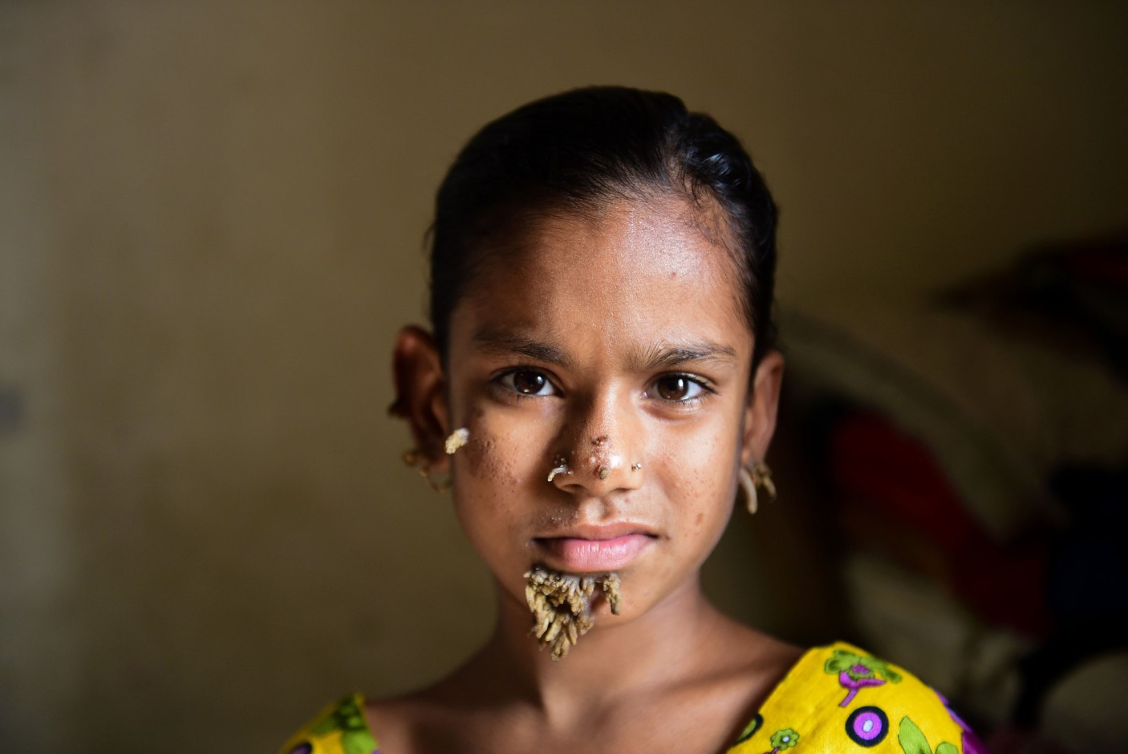 KAS NN PUUMEHE HAIGUS? 10aastase india tüdruku näol vohavad käsnad