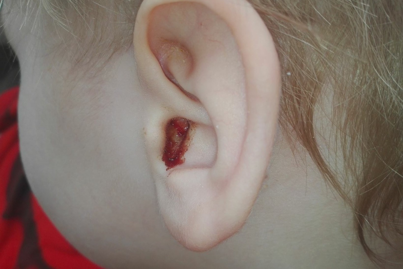 Nohust kõrvapõletikuni – haigena lasteaeda viidud lapsed nakatavad terveid mängukaaslasi