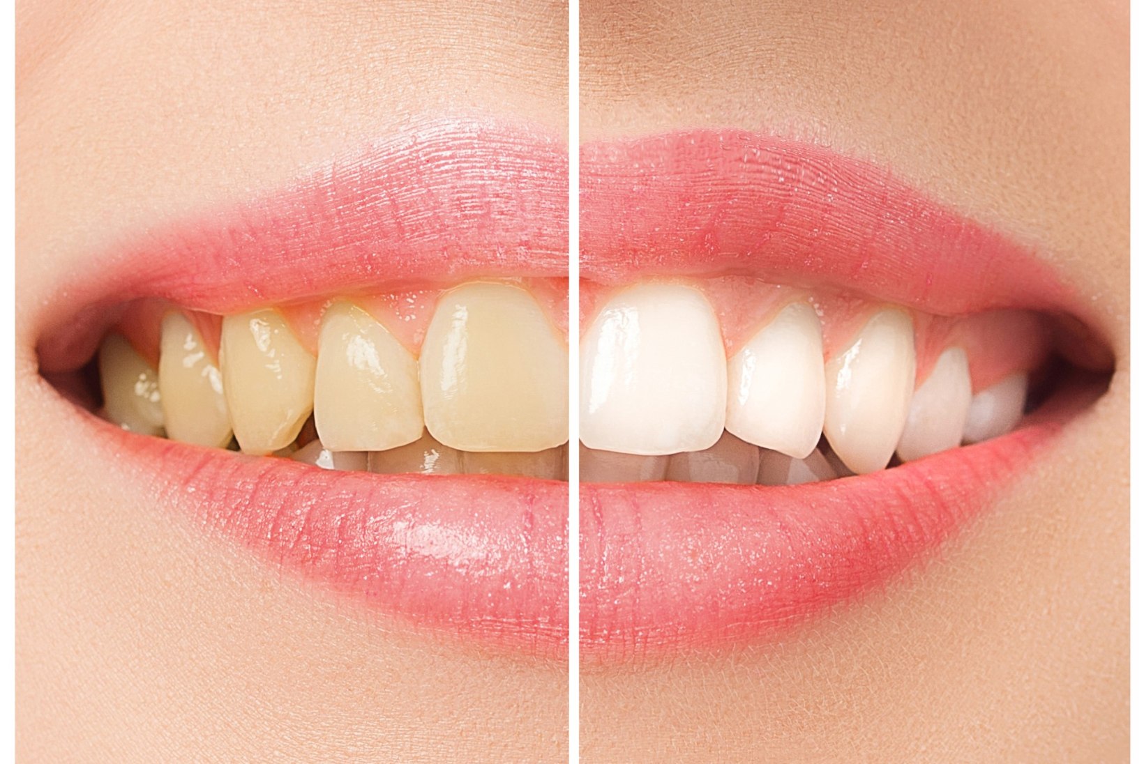 MIDA TEHA? 6 põhjust, miks su hambad kollaseks muutuvad