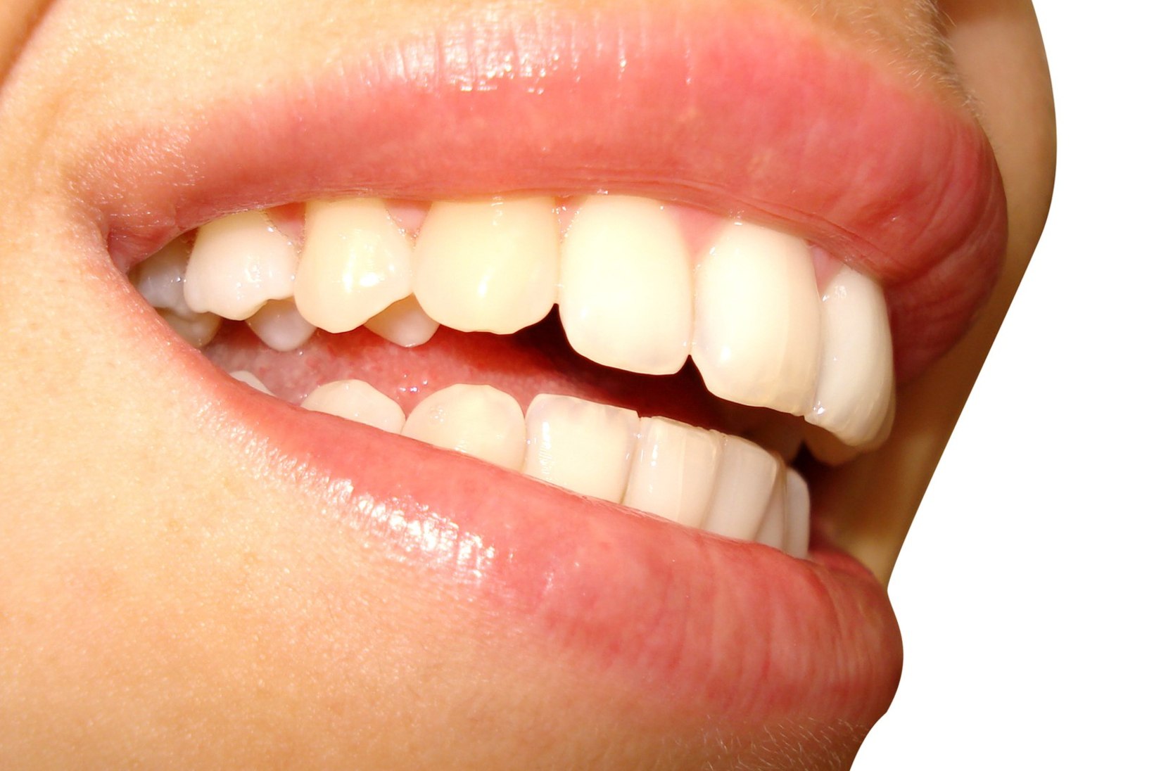 Hambaarstide liit täiskasvanute hambaravihüvitisest: mõtlematu raiskamine