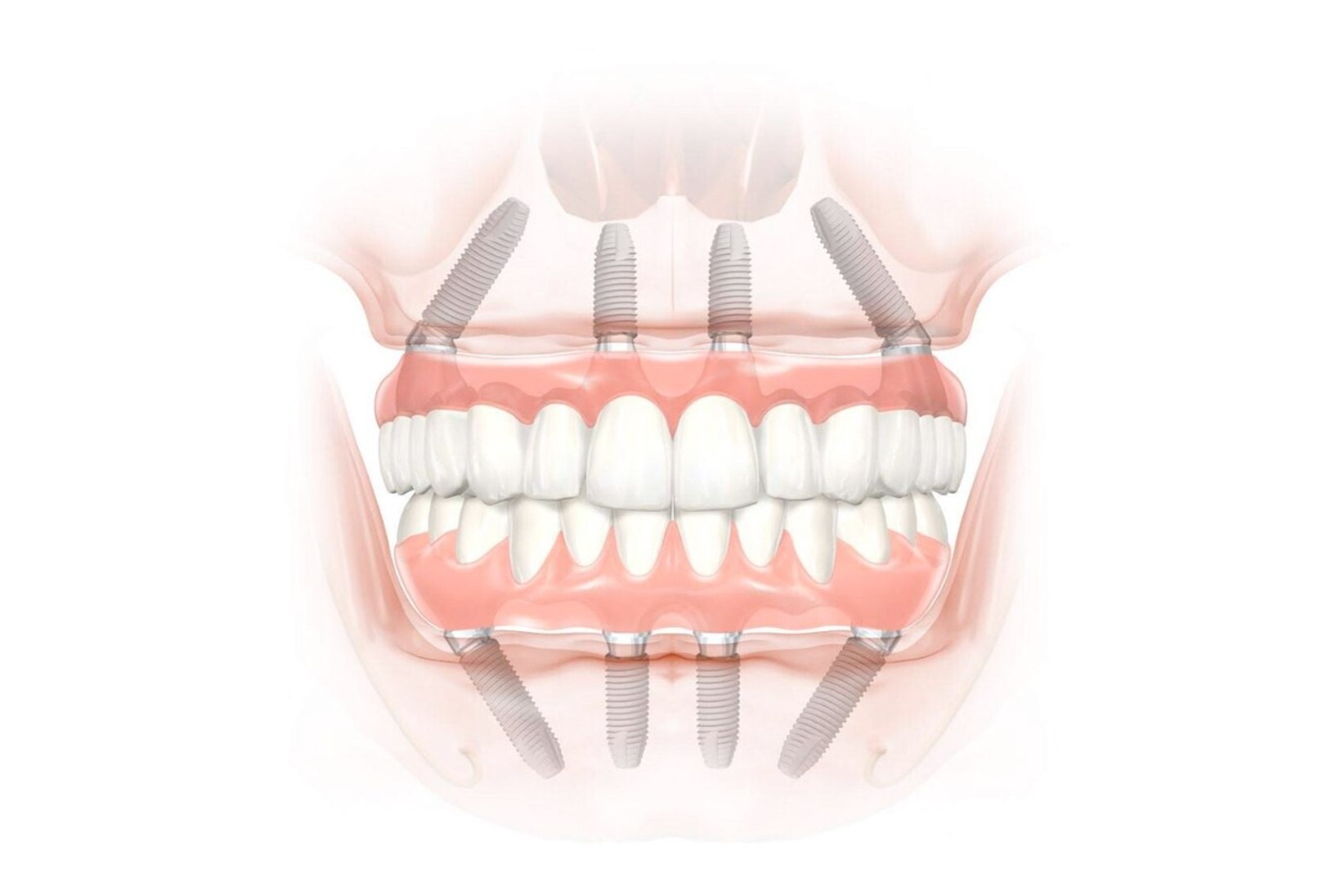 ILU ALGAB KAUNIST NAERATUSEST: kui olete mingil põhjusel hambad kaotanud, on lahenduseks ALL-ON-4 või ALL-ON-6 hambaimplantaadid!