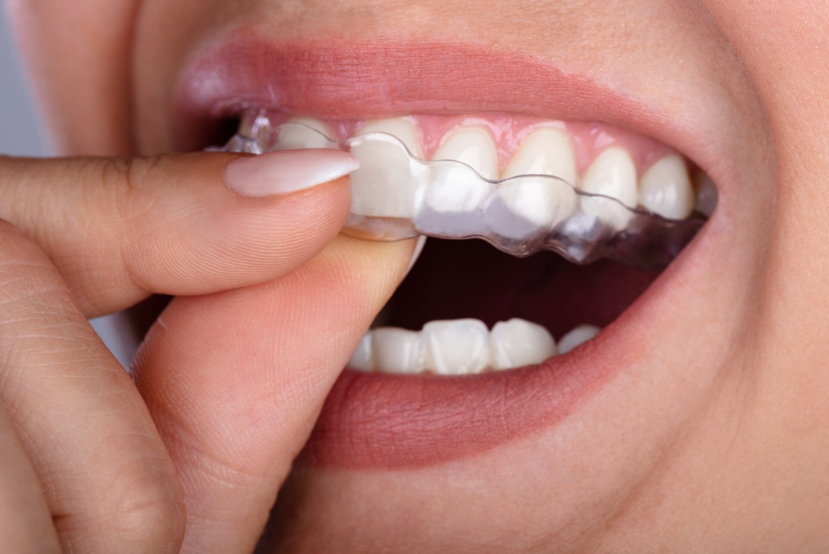 TÕHUS KAPERAVI: hambad saavad sirgeks diskreetselt ja valutult